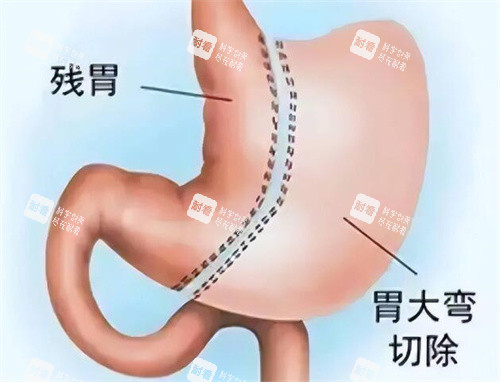 袖状胃切除手术改善展示图 袖状胃切除手术改善展示图