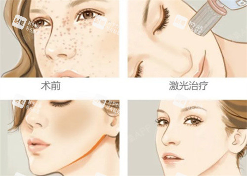激光祛斑术前术后对比 激光祛斑术前术后对比