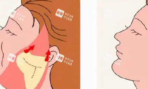 拉皮手术的术后对比图