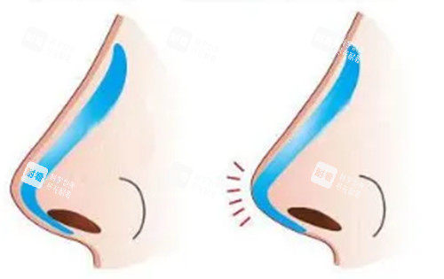 L型假体隆鼻示意图 L型假体隆鼻示意图