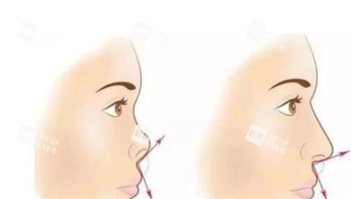 隆鼻前后对比示图 隆鼻前后对比示图