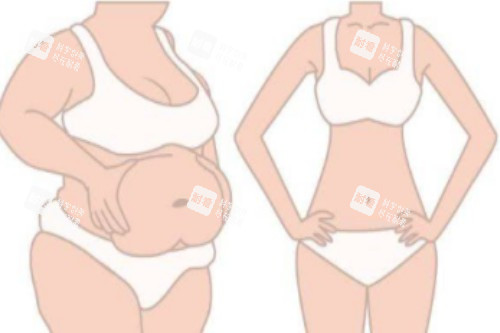 吸脂塑形前后对比图 吸脂塑形前后对比图