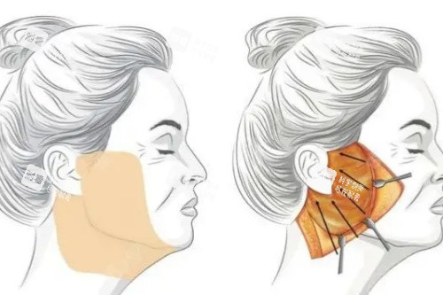 筋膜悬吊提升术卡通图