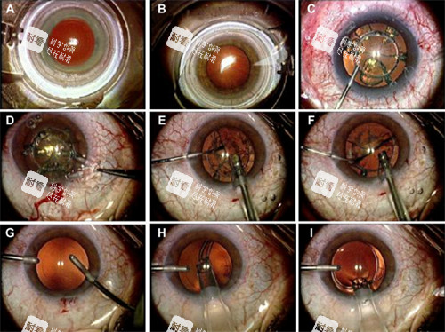全飞秒手术过程图解 全飞秒手术过程图解