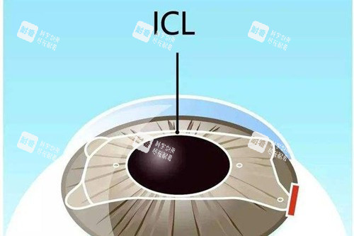 近视眼手术宣传