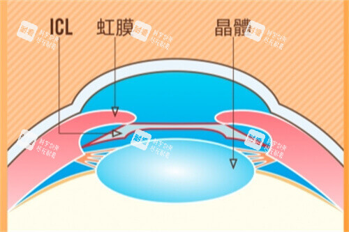 ICL示意图