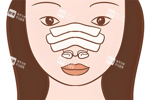 隆鼻修复术后图 隆鼻修复术后图