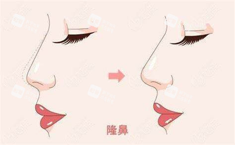 隆鼻术图 隆鼻术图