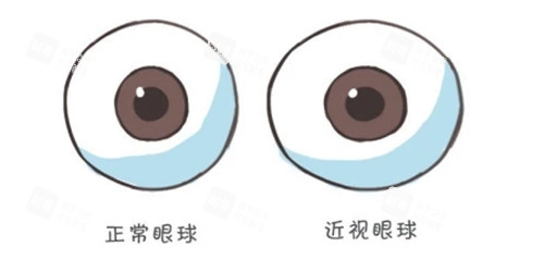 近视眼球照片 近视眼球照片