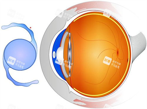术中使用的人工晶体
