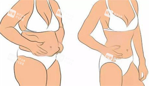 吸脂前后卡通图 吸脂前后卡通图