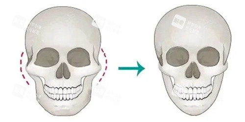 颧骨内推手术 颧骨内推手术