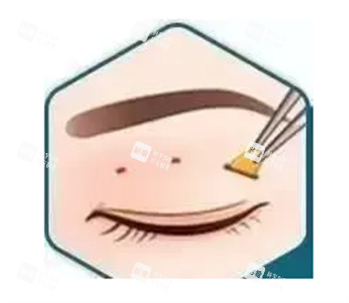 双眼皮三点术图