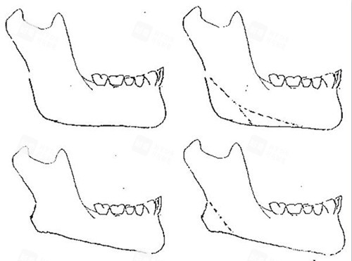 下颌角整形多次截骨示意图 下颌角整形多次截骨示意图
