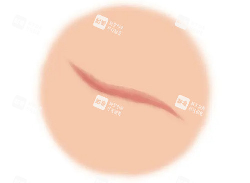 疤痕增生漫画示意图