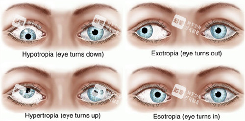 不同眼睛斜视和正常眼睛的对比 不同眼睛斜视和正常眼睛的对比
