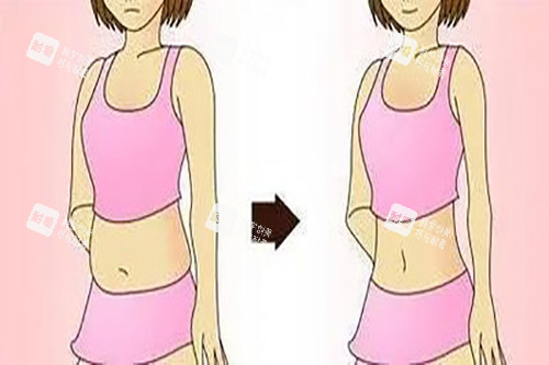 腰腹吸脂示意图卡通 腰腹吸脂示意图卡通