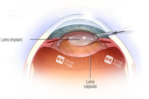 白内障晶体放入示意图 白内障晶体放入示意图