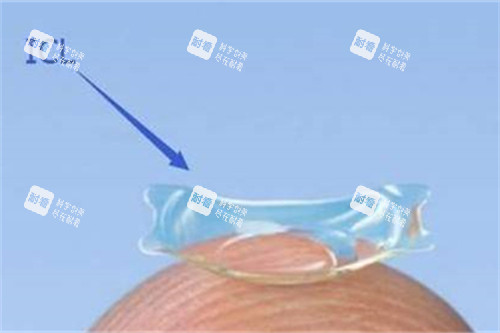 老人白内障手术用什么晶体好？4类晶体特点及选择因素详解