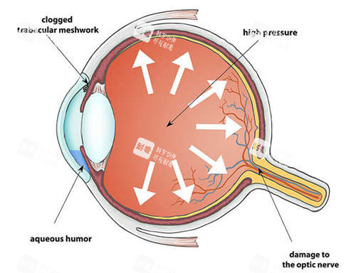 青光眼手术大概需要多少钱？手术类型及费用影响因素全说明