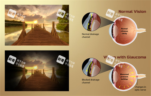 70岁老人青光眼该怎么治疗？药物、激光、手术方案全解析