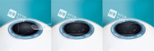 ICL晶体植入过程 ICL晶体植入过程