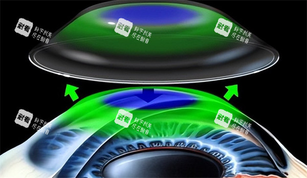 离焦软镜佩戴过程图解 离焦软镜佩戴过程图解