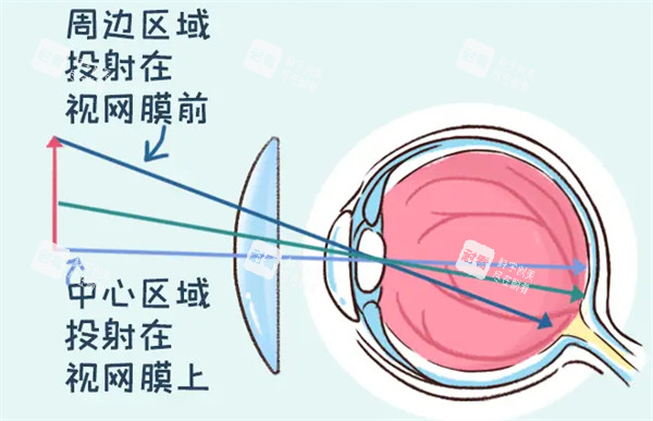 离焦软镜矫正原理图解 离焦软镜矫正原理图解