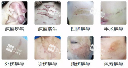 不同疤痕的类型