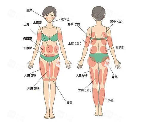 吸脂身体部位图片
