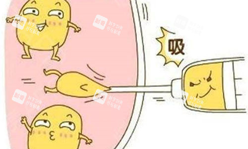 吸脂手术示意图