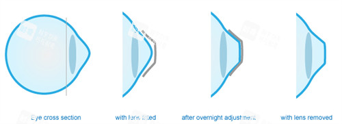 角膜塑形镜可以改善眼表曲度