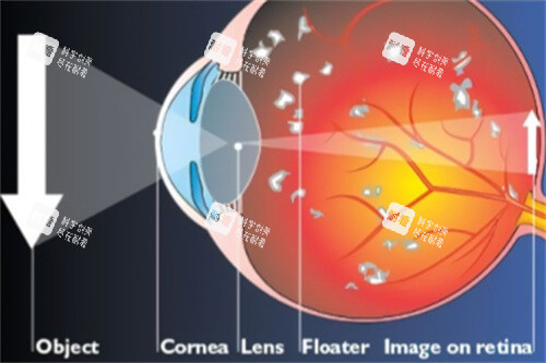 飞蚊症眼球结构示意图