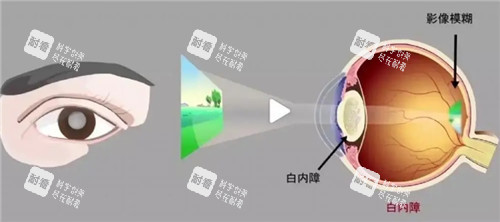 白内障视力表现图