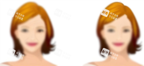 热玛吉前后对比 热玛吉前后对比