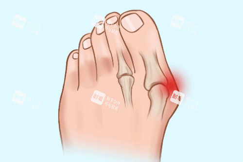 大脚骨疼痛卡通图