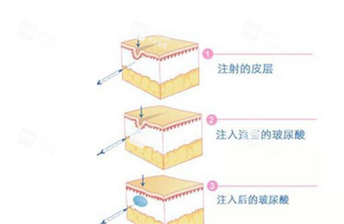 玻尿酸填充原理动画演示图