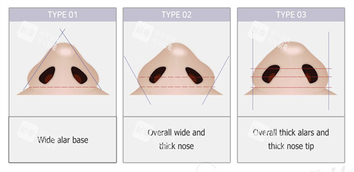 鼻翼缩小的流程图