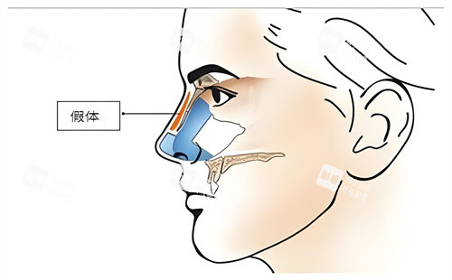 硅胶假体隆鼻手术