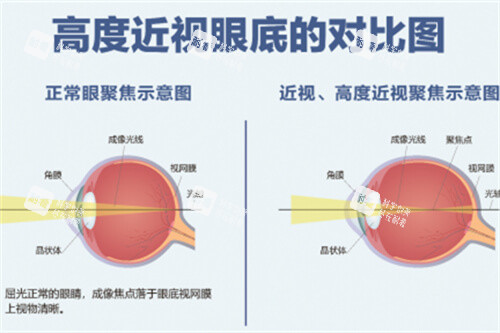 高度近视眼底的对比图 高度近视眼底的对比图