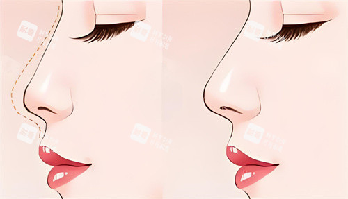 隆鼻前后对比动画图 隆鼻前后对比动画图