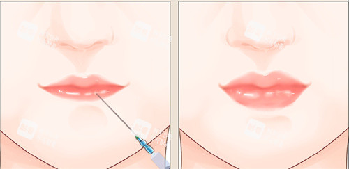 注射丰唇手术