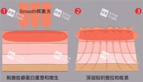 刺激胶原深层提拉