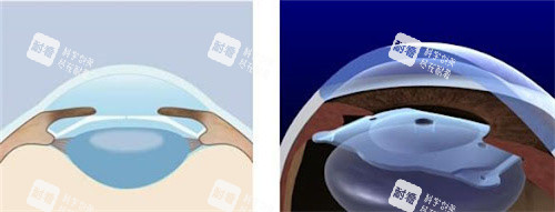 ICLV5晶体植入位置