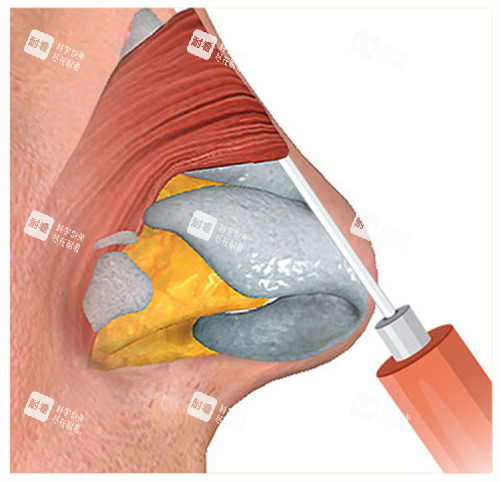 玻尿酸注射隆鼻过程图