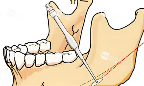 下颌角手术过程 下颌角手术过程