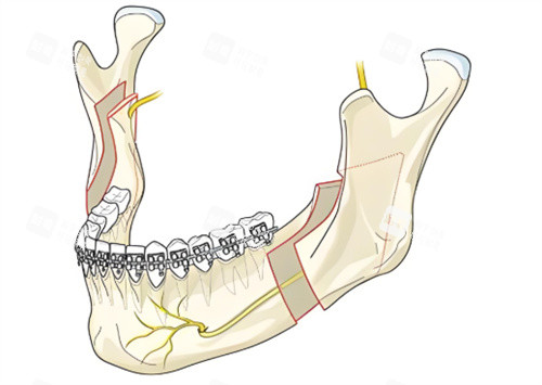下颌角手术动画 下颌角手术动画