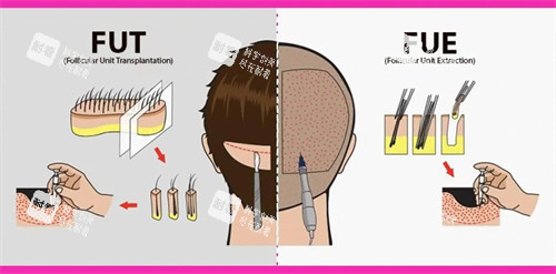 两种植发手术对比图
