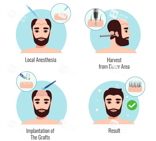 植发手术过程图