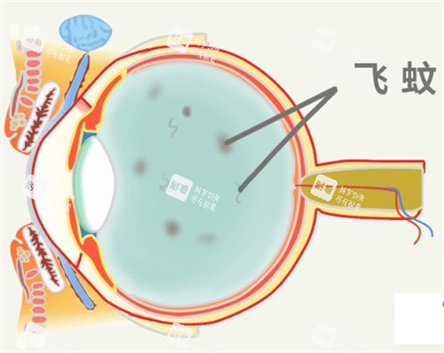 飞蚊症图片 飞蚊症图片